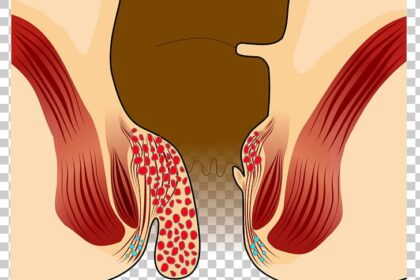 İç Hemoroid Nedir?